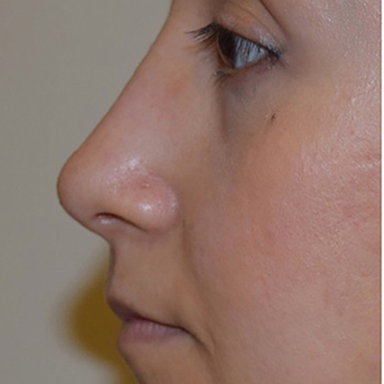Пациентке была произведена ринопластика (пластика носа).