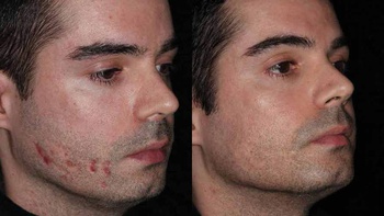 Шлифовка кожи 3 месяца после 4 процедур с перерывом в 1 месяц (ResurFX)