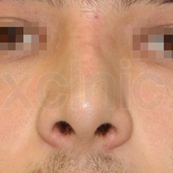 Пациенту была произведена ринопластика (пластика носа).