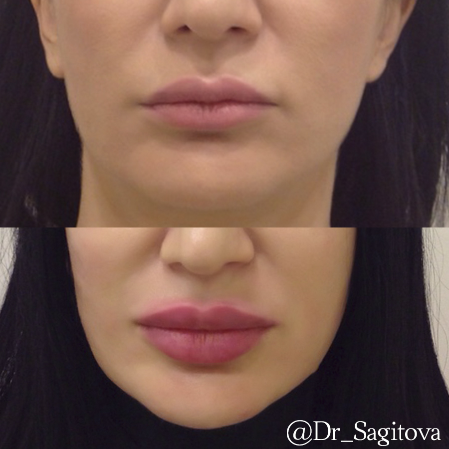 Приложение увеличивающее губы. Коррекция губ гиалуроновой кислотой 1 мл. Контурирование губ гиалуроновой кислотой. Филлер Stylage 1 мл в губы до и после.